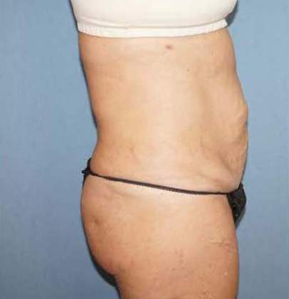 Tummy Tuck Before And After Photo