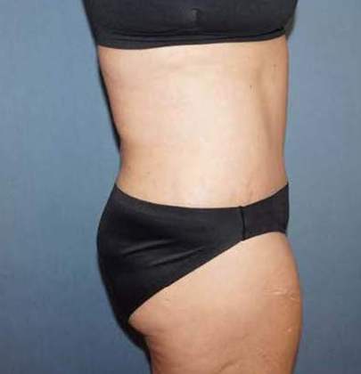 Tummy Tuck Before And After Photo