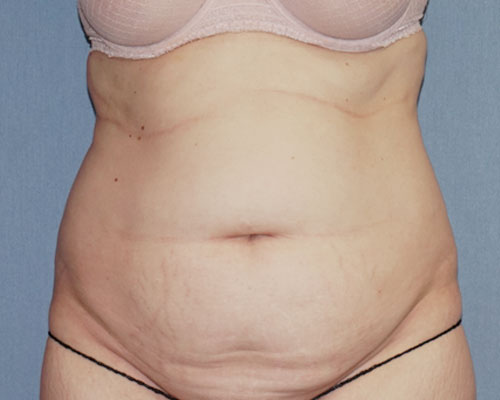 Tummy Tuck Before And After Photo