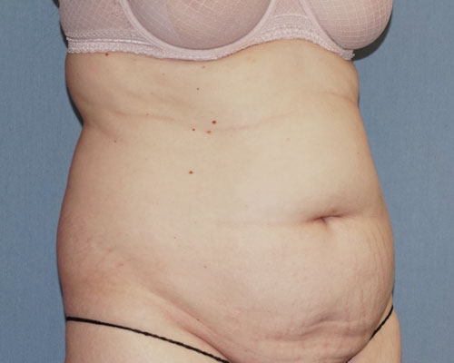 Tummy Tuck Before And After Photo