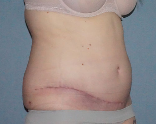 Tummy Tuck Before And After Photo