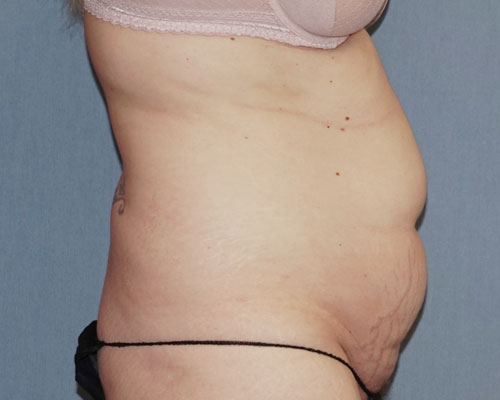 Tummy Tuck Before And After Photo