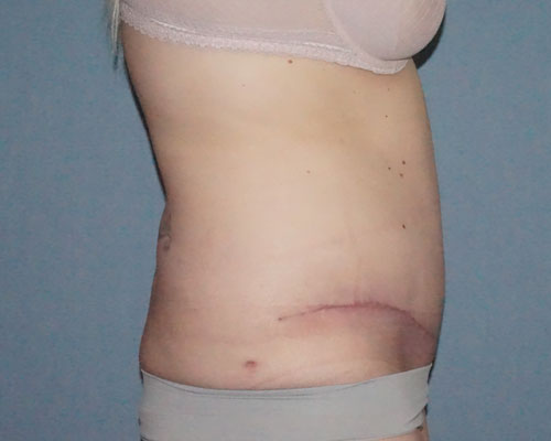 Tummy Tuck Before And After Photo