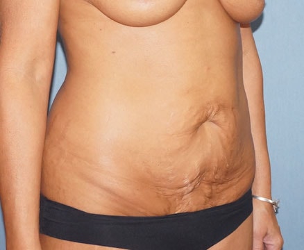 Tummy Tuck Before And After Photo