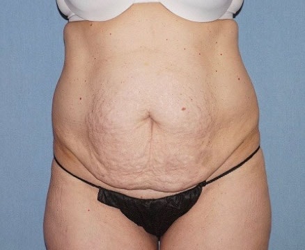 Tummy Tuck Before And After Photo