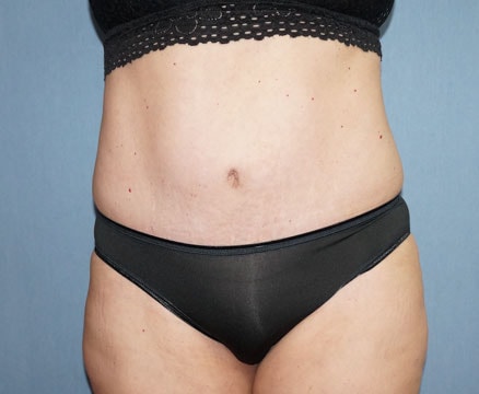 Abdominoplasty & Liposuction of Posterior Hips Before And After Patient 43