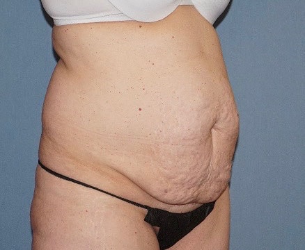 Tummy Tuck Before And After Photo