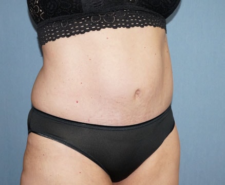 Tummy Tuck Before And After Photo