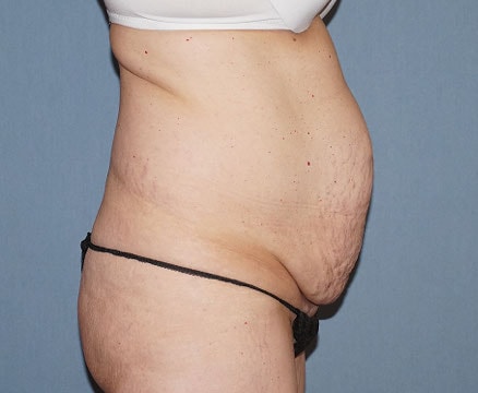 Tummy Tuck Before And After Photo