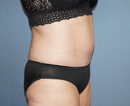 Tummy Tuck Before And After Photo