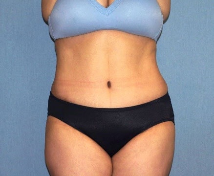 Tummy Tuck Before And After Photo