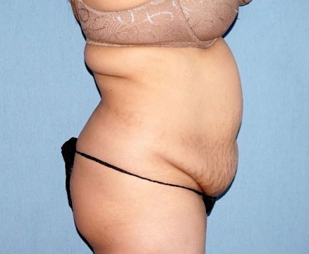 Tummy Tuck Before And After Photo