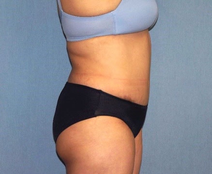 Tummy Tuck Before And After Photo