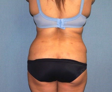 Tummy Tuck Before And After Photo