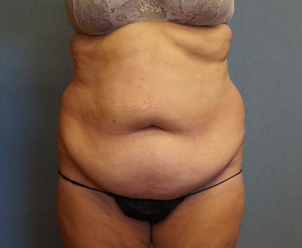 Tummy Tuck Before And After Photo