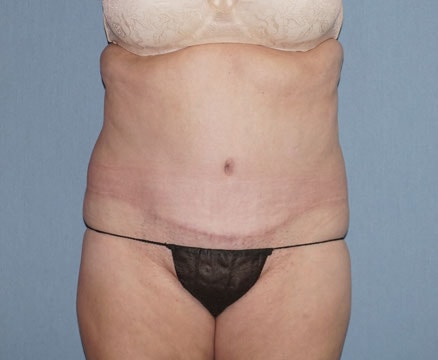 Abdominoplasty & Liposuction of Posterior Hips Before And After Patient 45