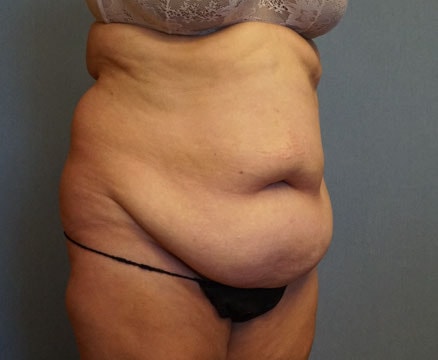 Tummy Tuck Before And After Photo