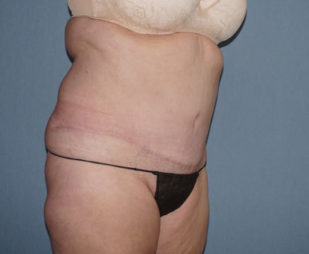 Tummy Tuck Before And After Photo