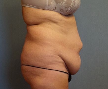 Tummy Tuck Before And After Photo