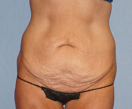 Tummy Tuck Before And After Photo