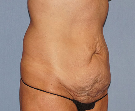 Tummy Tuck Before And After Photo