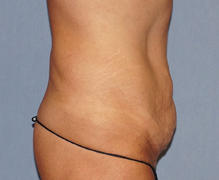 Tummy Tuck Before And After Photo