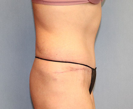 Tummy Tuck Before And After Photo