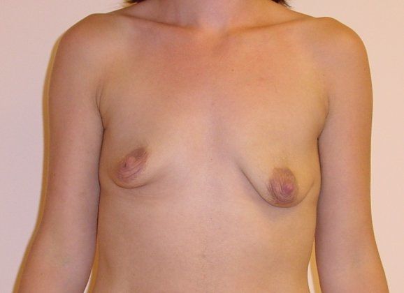 Breast Augmentation with Lift Before And After Photo