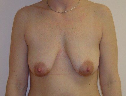 Breast Augmentation with Lift Before And After Photo