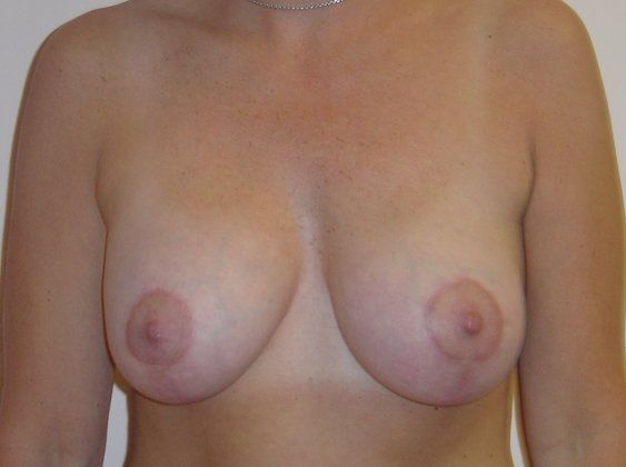Breast Augmentation with Lift Before And After Patient 2