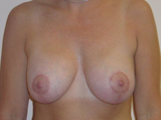 Breast Augmentation with Lift Before And After Photo