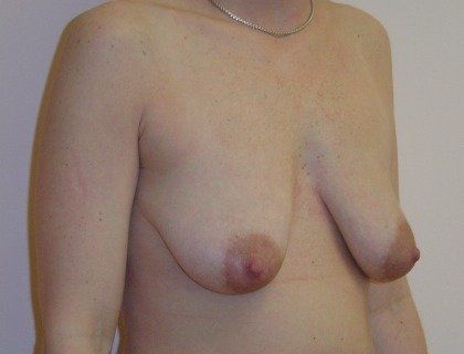 Breast Augmentation with Lift Before And After Photo