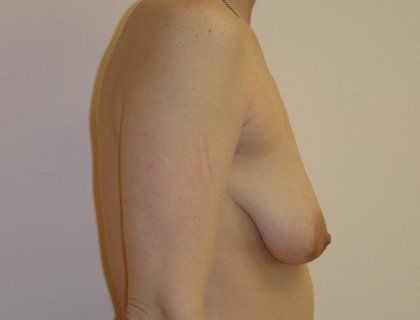 Breast Augmentation with Lift Before And After Photo