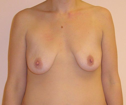 Breast Augmentation with Lift Before And After Photo