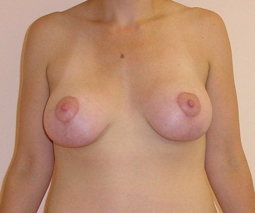 Breast Augmentation with Lift Before And After Patient 3