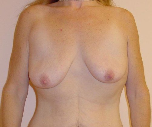 Breast Augmentation with Lift Before And After Photo