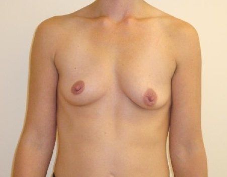 Breast Augmentation with Lift Before And After Photo