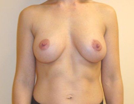 Breast Augmentation with Lift Before And After Patient 5