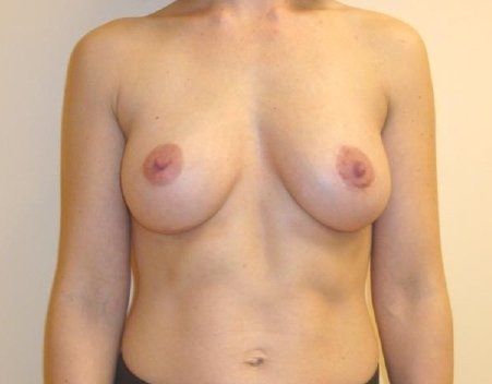 Breast Augmentation with Lift Before And After Photo