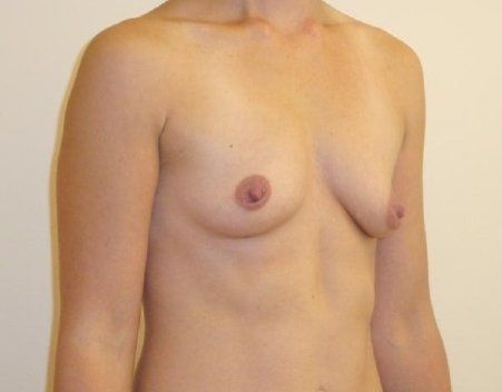 Breast Augmentation with Lift Before And After Photo