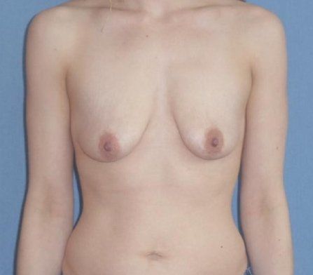 Breast Augmentation with Lift Before And After Photo