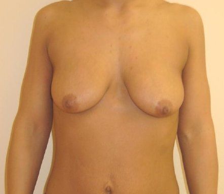 Breast Augmentation with Lift Before And After Photo