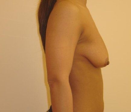 Breast Augmentation with Lift Before And After Photo