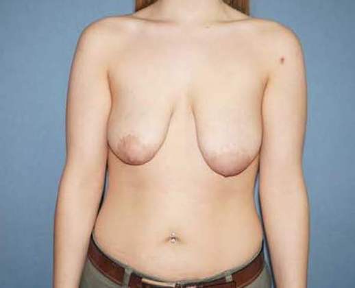 Breast Augmentation with Lift Before And After Photo