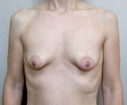 Breast Augmentation with Lift Before And After Photo