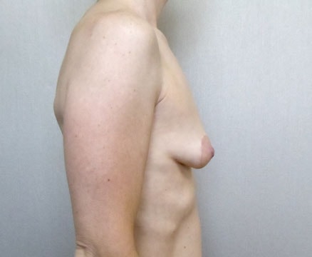 Breast Augmentation with Lift Before And After Photo