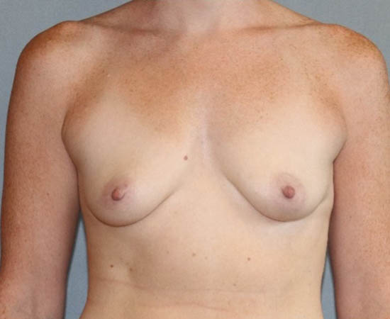 Breast Augmentation Before And After Photo