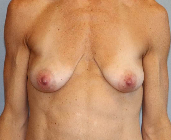 Breast Augmentation Before And After Photo