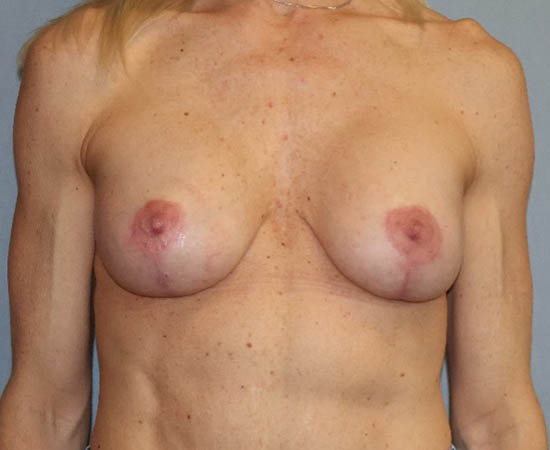 Breast Augmentation Before And After Photo