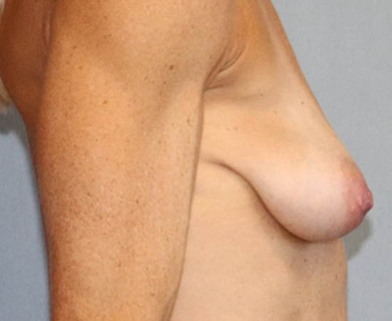 Breast Augmentation Before And After Photo